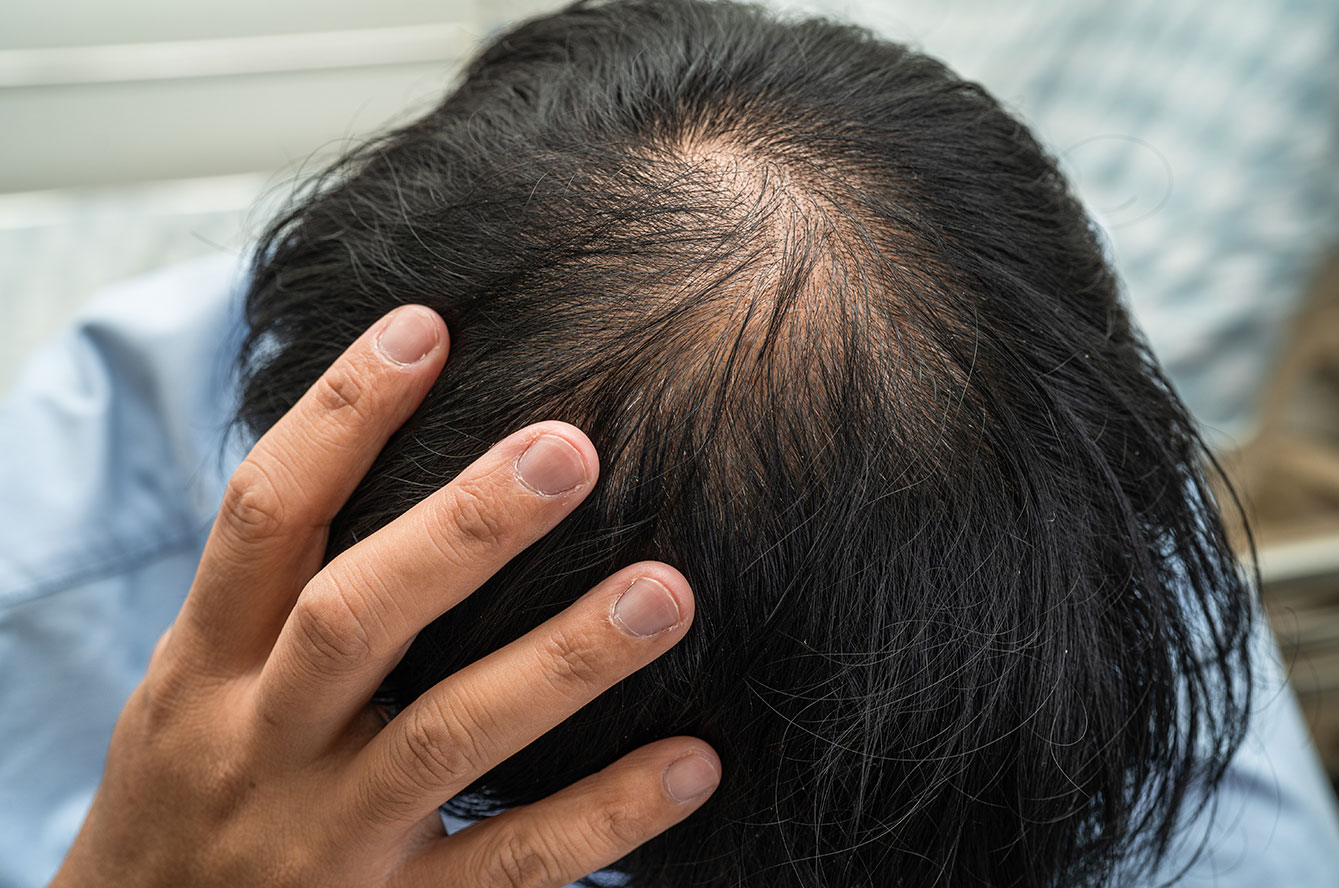 Chute de cheveux : comprendre les causes et trouver des solutions adaptées à la calvitie