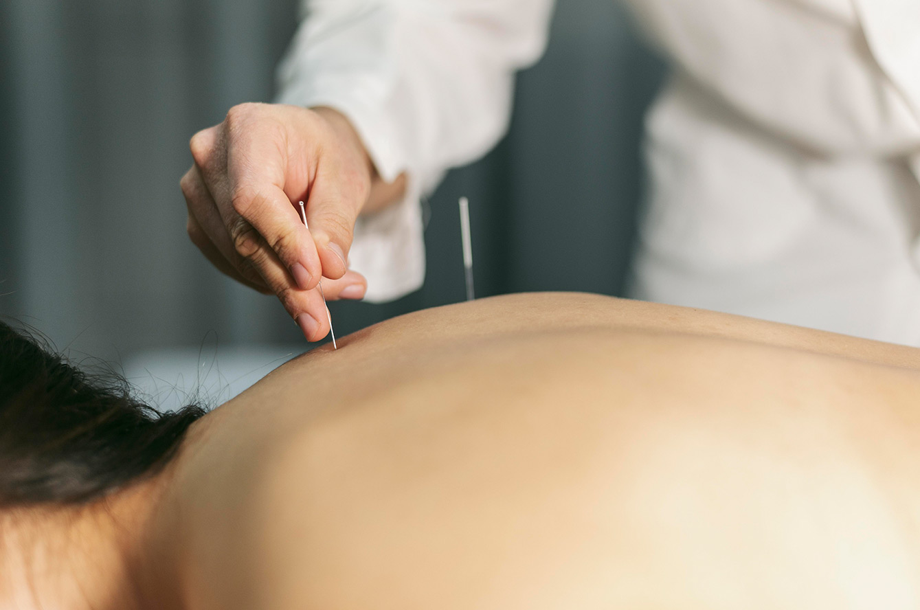 Acupuncture : soulagez vos douleurs et améliorez votre bien-être