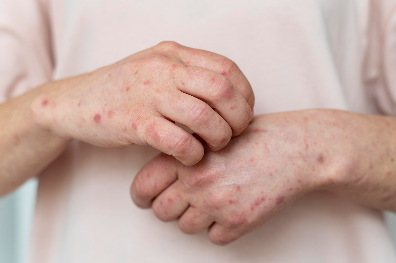 Mpox ou variole du singe : tout savoir pour mieux se protéger