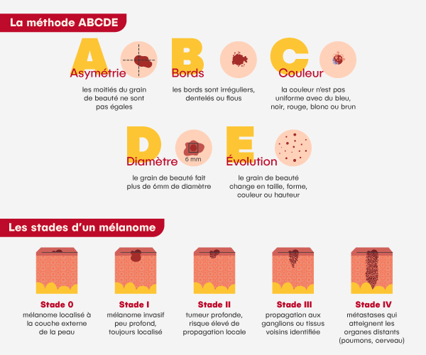 Grains de beauté : la méthode ABCDE et les différents stades d'un mélanome