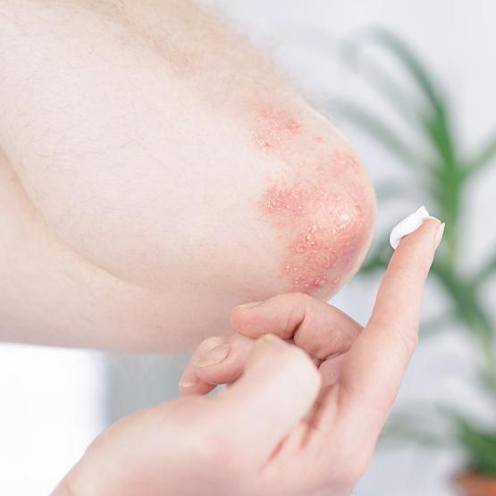 L’eczéma, peut-on l’éviter ? Comment le traiter ?